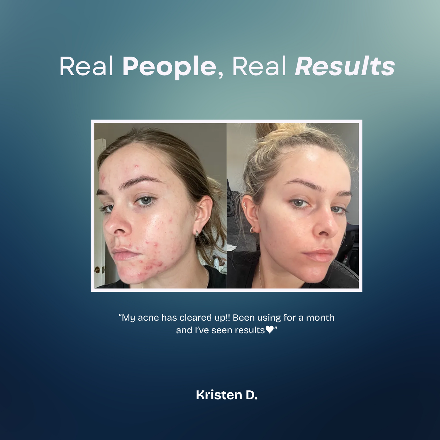 Acne Creamy Foam Facial Wash