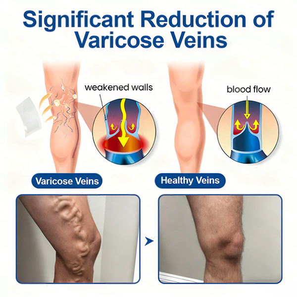 🇬🇧👨‍⚕️✅VeinTarget Microneedle Patch⚡Instant Relief, Long-Term Results