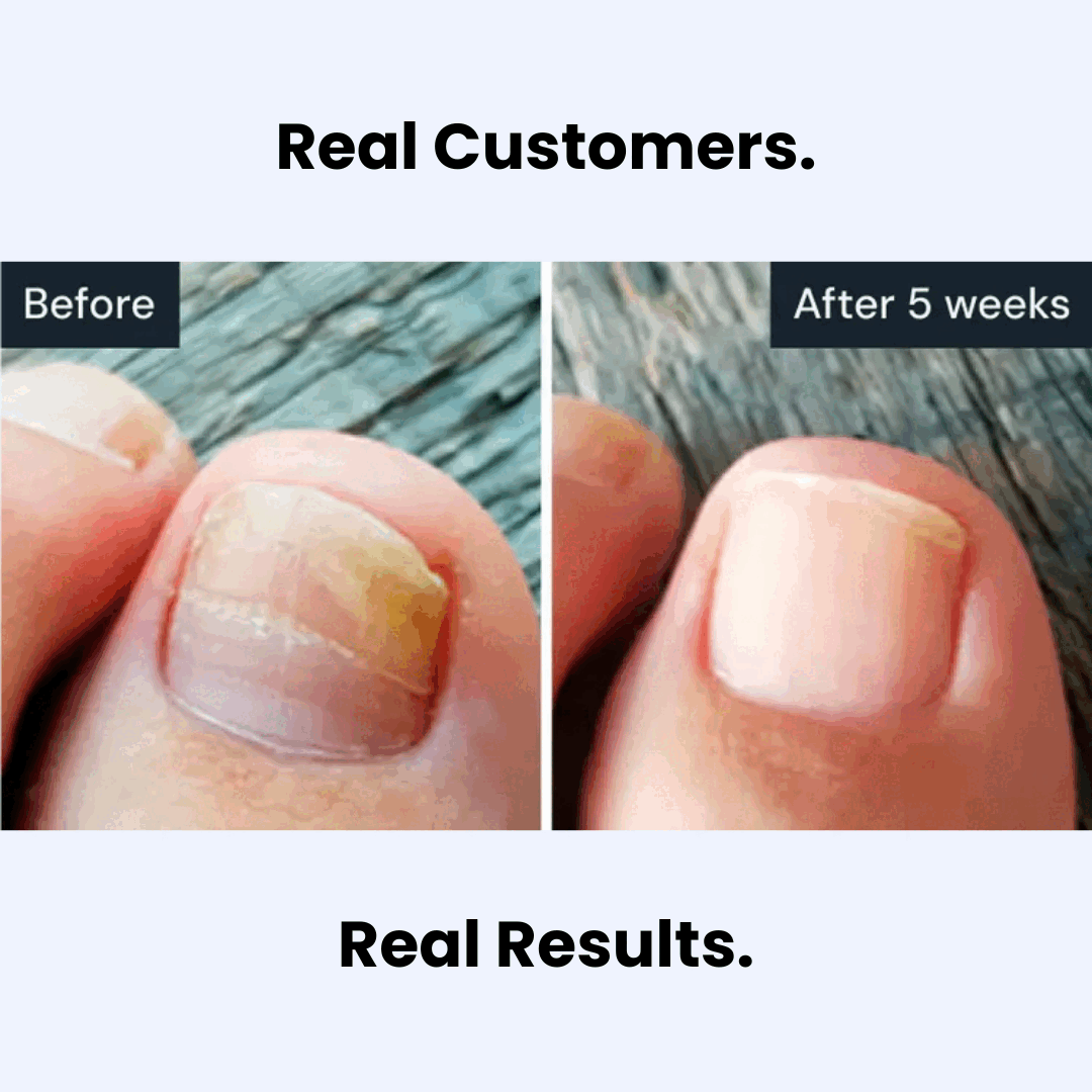 Viralaluna™ Antifungal Pen