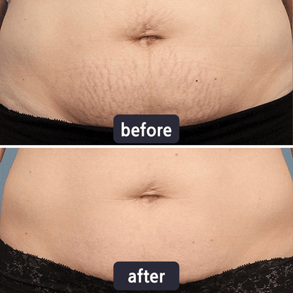 Viralaluna Scar Removal Cream