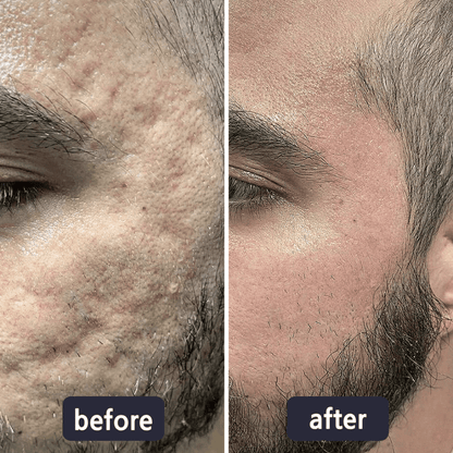 Viralaluna Scar Removal Cream