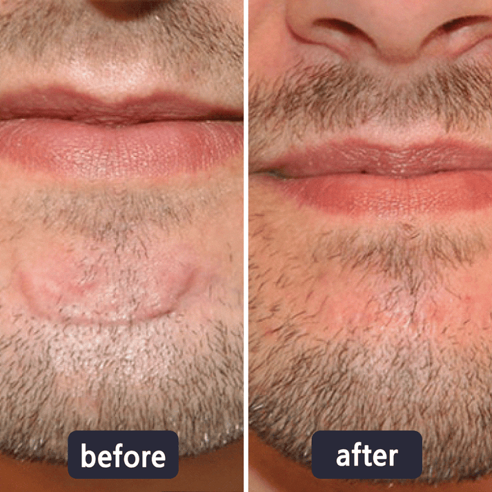 Viralaluna Scar Removal Cream