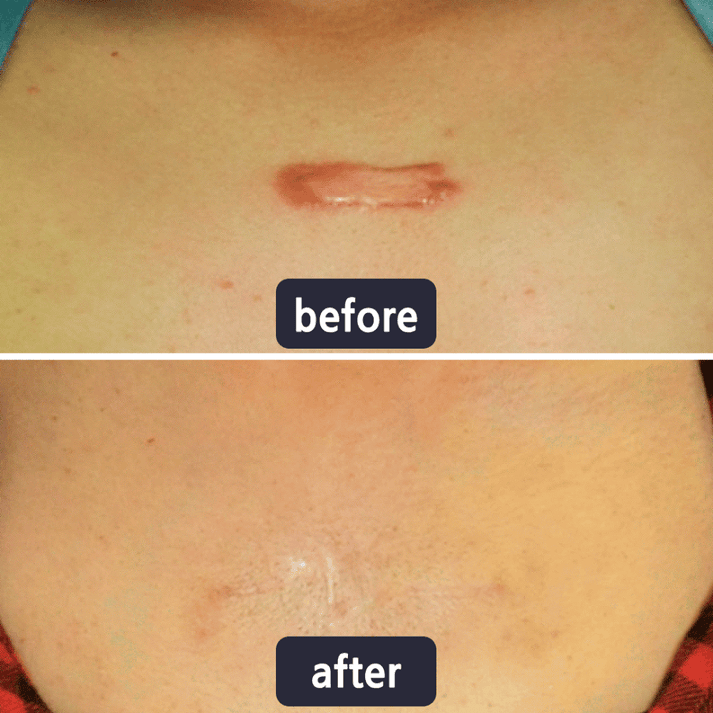 Viralaluna Scar Removal Cream