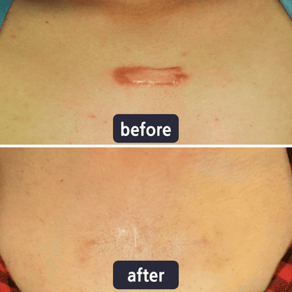 Viralaluna Scar Removal Cream